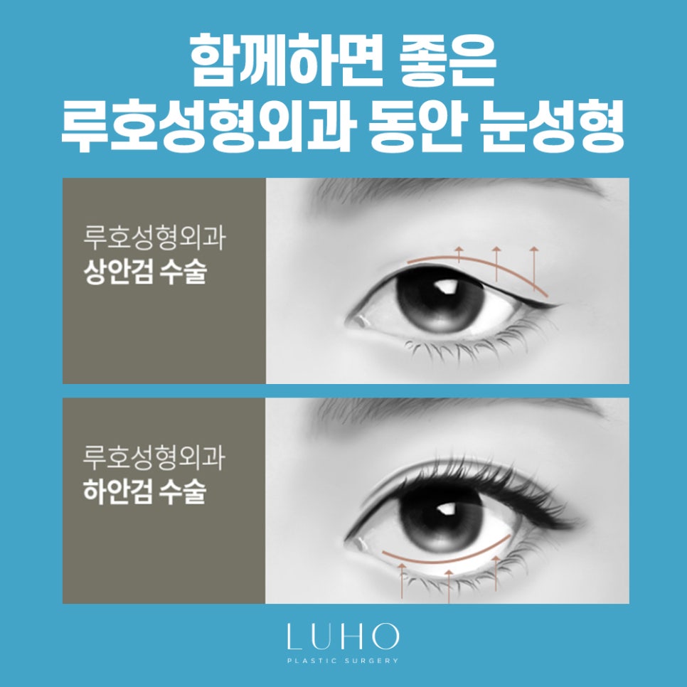 눈 밑 그늘 개선, 루호성형외과 눈밑지방재배치 관련 이미지 5