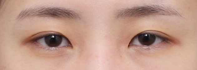 내 눈에 맞는 디자인 설계를 거친 눈재수술 후기 관련 이미지 3