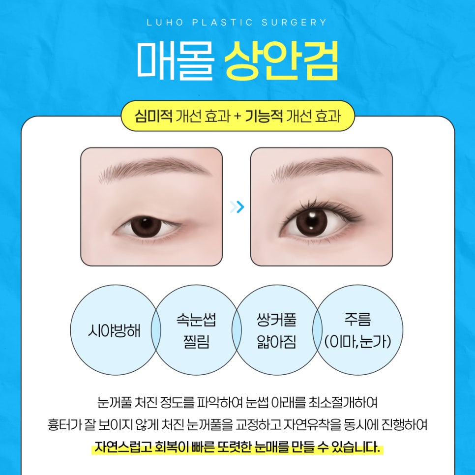처진 눈꺼풀로 나이가 더 들어 보인다면? 관련 이미지 4