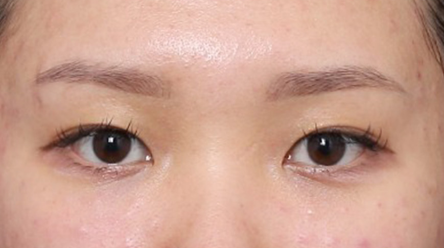 A More Open, Face-Appropriate Eye Shape After Outer-Corner Thread Lifting image 3