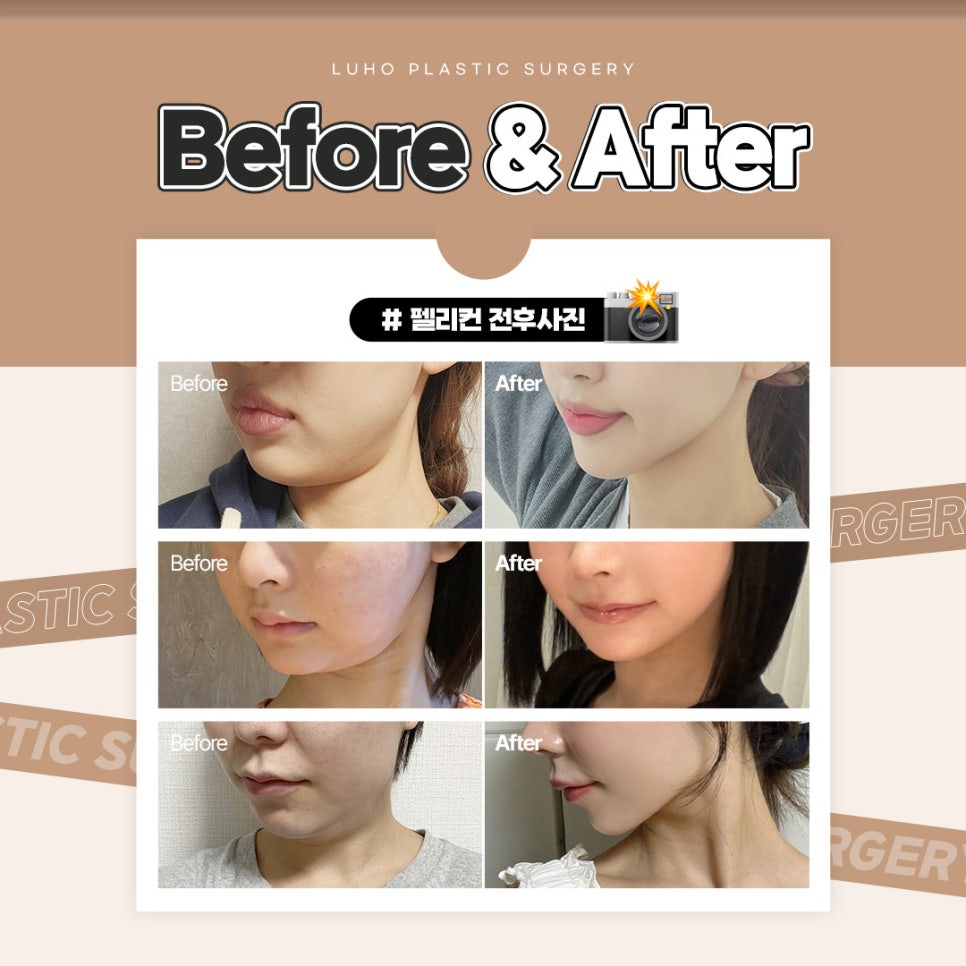 Luho Plastic Surgery Pelican Surgery to Regain a Hidden Jawline image 2