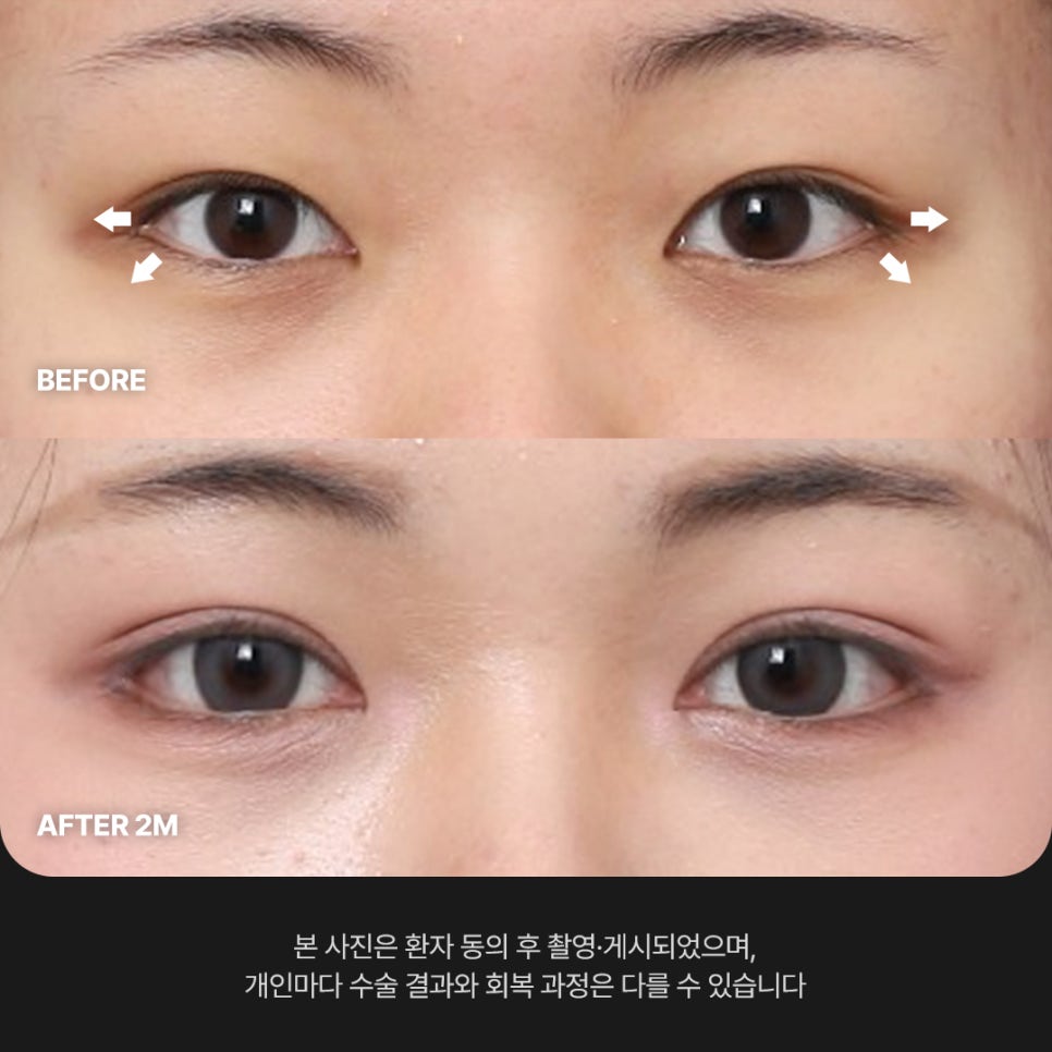 Ruhos Plastic Surgery — Real Review of Outer and Lower Eye Corner Surgery for Tired-Looking Eyes Before and After image 2