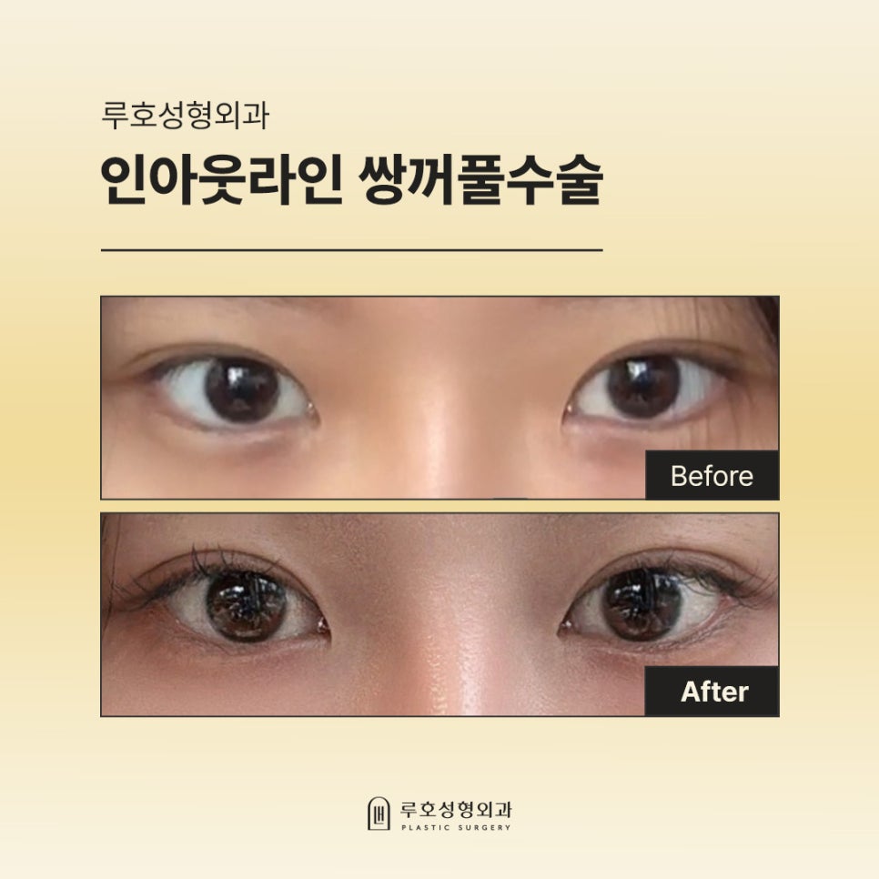 How Double Eyelid Surgery at Sinsa Station Changed the Appearance of the Eyes: A Look at Before-and-After Photos image 1