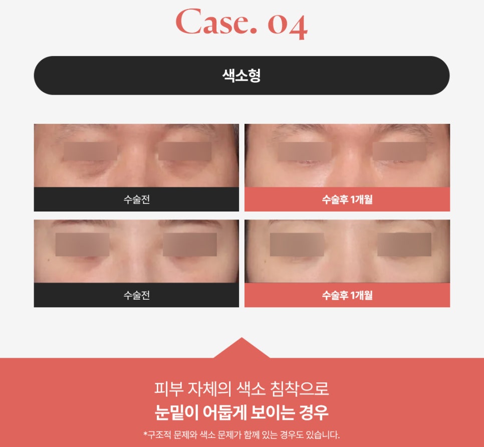 How to Get Rid of Dark Circles: A Look at Under-Eye Fat Repositioning Reviews Near Sinsa Station image 5