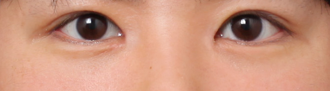 Before and After Male Eye Surgery at Sinsa Station That Created a Positive Impression image 5