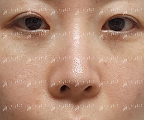 A Review of Eye & Nose Revision Surgery That Addressed the Shortcomings of Previous Surgery image 4