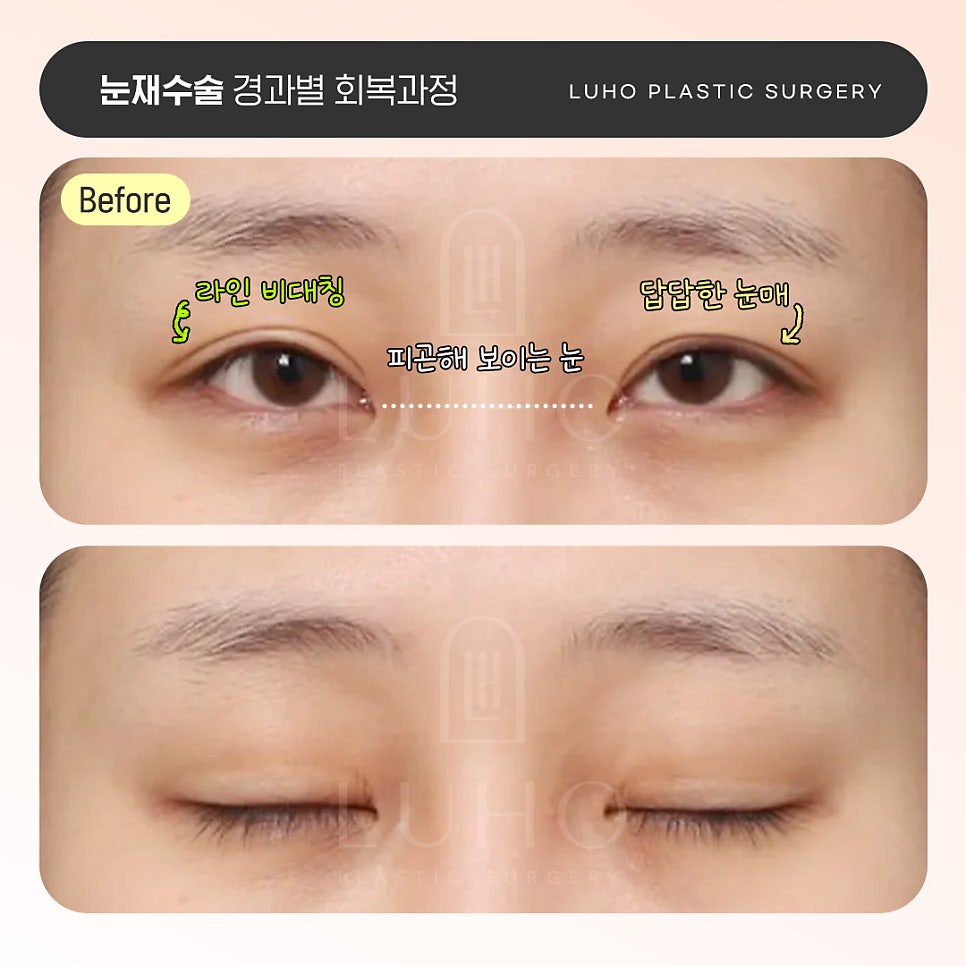 Luho Plastic Surgery Revision Eyelid Surgery Recovery Process by Stage image 1