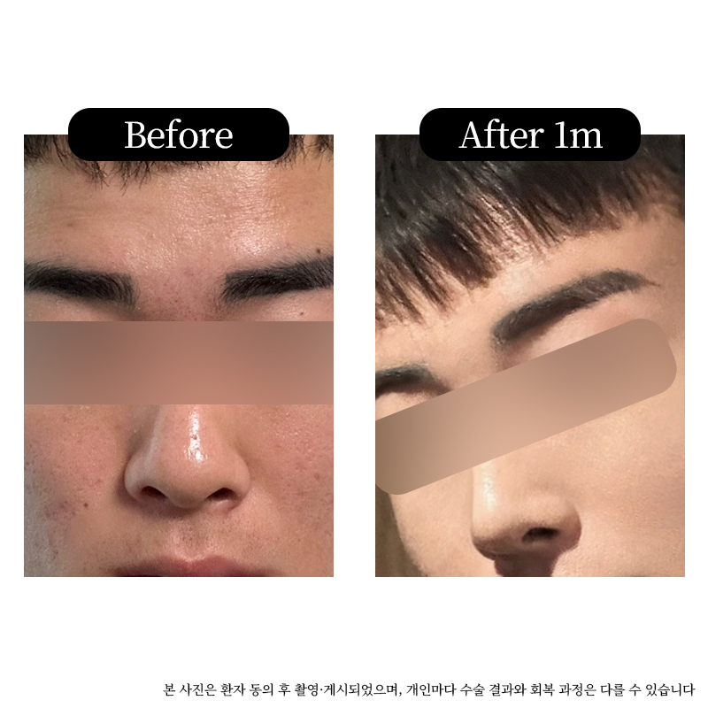 Real Before-and-After Review of Male Rhinoplasty at Luho Plastic Surgery Near Sinsa Station image 4