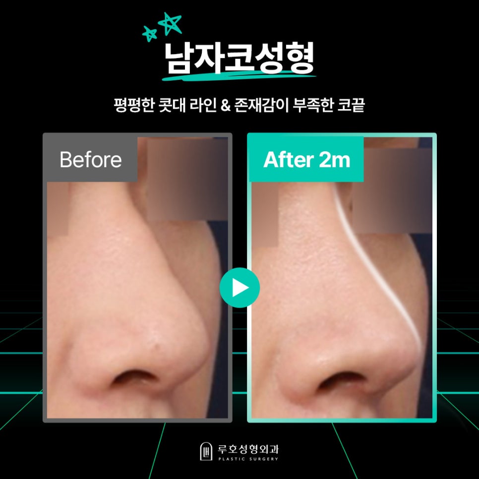 예전과 다른 분위기를 만들어준 남자코성형 효과 관련 이미지 1