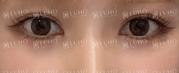 Improving an Eye Appearance That Had Lost Definition 8 Years After Buried-Suture Surgery image 8