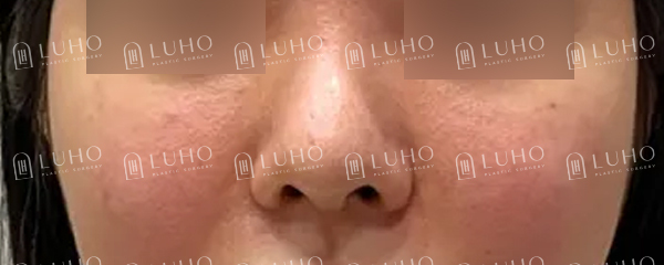 Redesigning a Bulbous Nose After 9 Years: Revision Rhinoplasty image 2