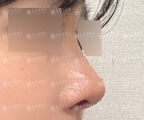 기존 이미지를 유지하면서 라인만 정돈한 코수술 관련 이미지 7