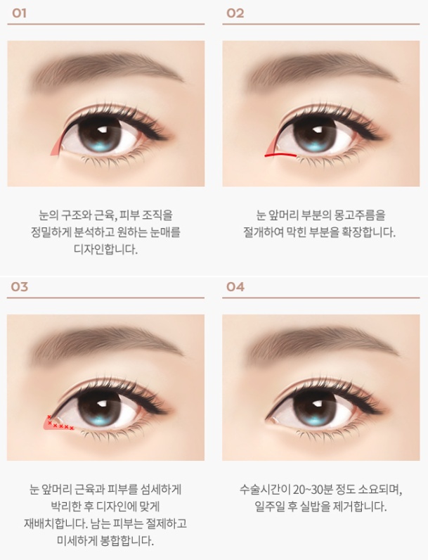 신사역 앞트임수술 경과별 비교하기 관련 이미지 3