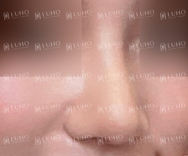 웃을 때 퍼져 보이는 코, 콧대부터 코끝까지 정리한 코수술 관련 이미지 6