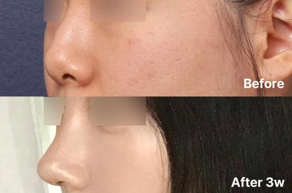 Before and After Gangnam Rhinoplasty for a Hump Nose: Refining the Prominent Hump for a New Look image 1