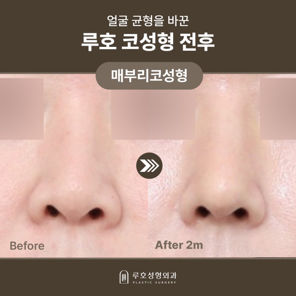 A Real Sinsa Station Rhinoplasty Case That Created a Harmonious Face image 1