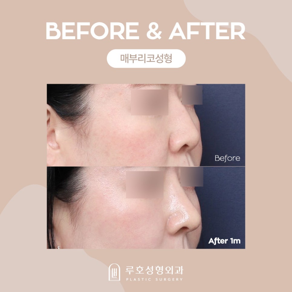 Hump Nose Surgery: Why Is It Needed? image 3
