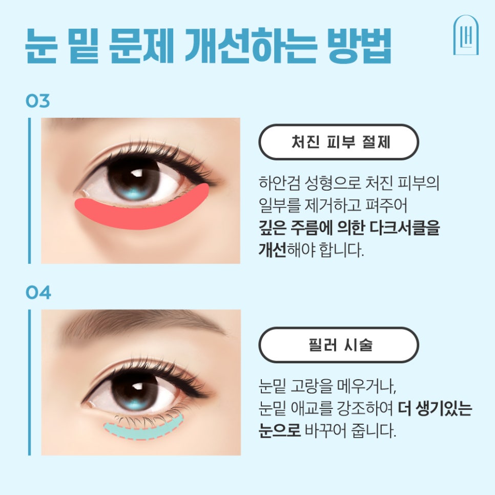 눈 밑 그늘 개선, 루호성형외과 눈밑지방재배치 관련 이미지 3