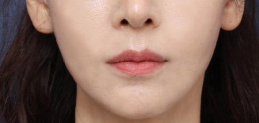 Reducing Nasolabial Folds, Before and After Thread Lifting at Sinsa Station image 5