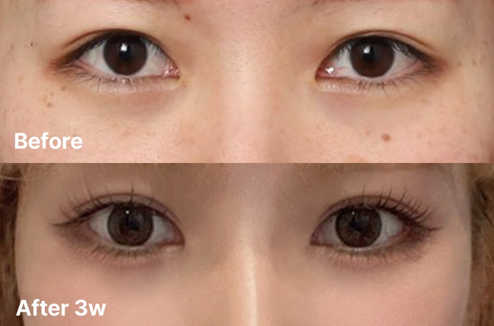 Improving an Eye Appearance That Had Lost Definition 8 Years After Buried-Suture Surgery image 1