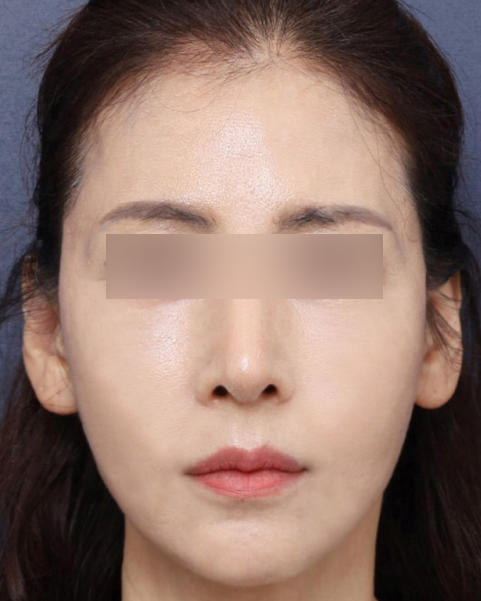 심부볼 처짐 고민 해결한 신사역 실리프팅 솔직 후기 관련 이미지 5