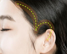 The Advantages of Lifting at a Glance: Ruho Plastic Surgery Mini Lifting image 6