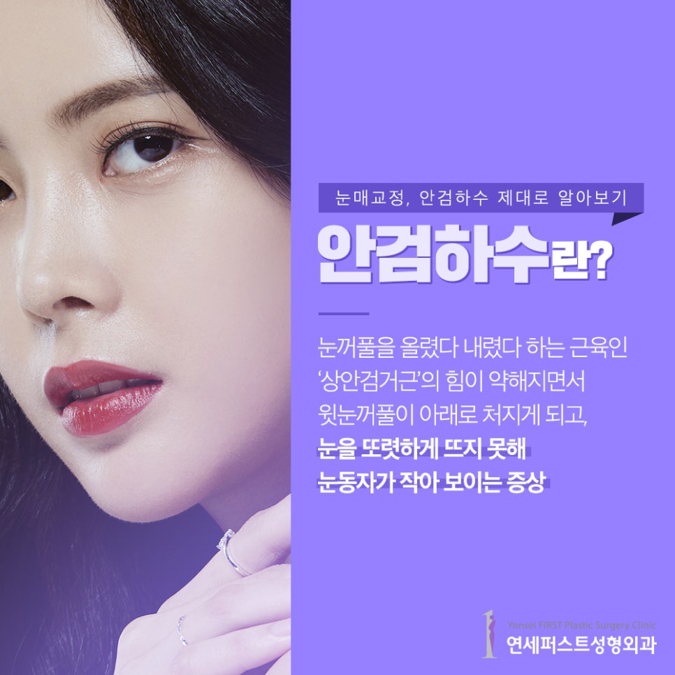 안검하수 제대로 알고 눈매교정 알아보자! 관련 이미지 2