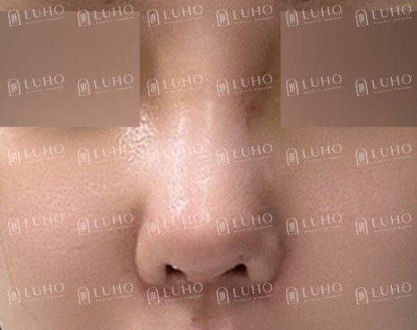 휜코를 교정하여 균형을 되찾은 코재수술 사례 관련 이미지 4