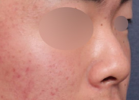 A Real Review of Men’s Rhinoplasty at Sinsa Station That Completed a Masculine Line image 3