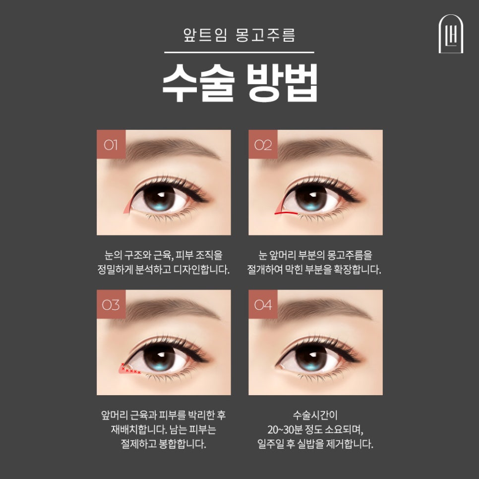 Inner Corner Epicanthoplasty for a Brighter Eye Shape image 5