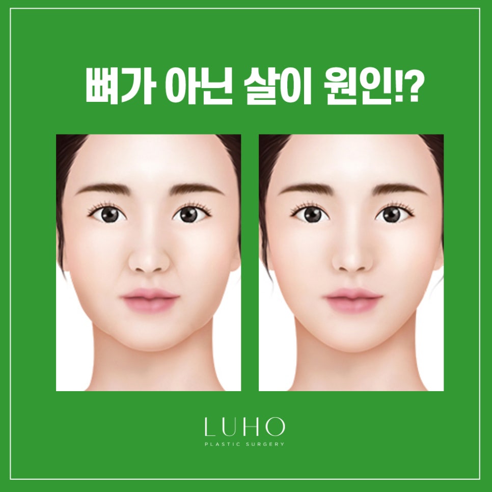 루호성형외과의 쏙 오프 지방흡입! 관련 이미지 2