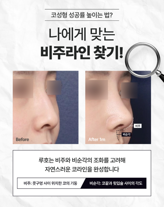 얼굴과의 조화를 맞춘 코성형, 전후 변화 살펴보기 관련 이미지 4