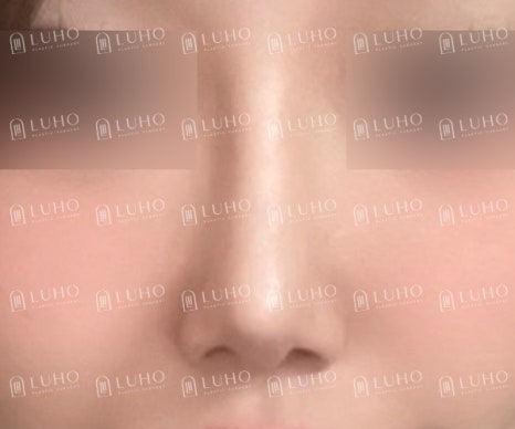 직반라인으로 디자인해 또렷한 존재감을 더한 코수술 효과 관련 이미지 10