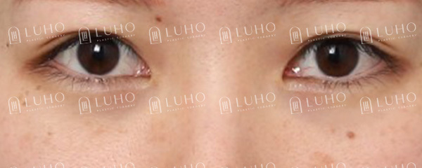 Improving an Eye Appearance That Had Lost Definition 8 Years After Buried-Suture Surgery image 2