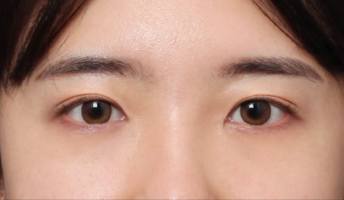 A Case of Forehead Lift Surgery That Gave a Heavy Appearance More Definition image 5