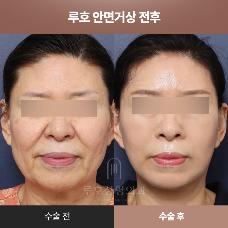 신사역 성형외과, 리얼 안면거상 후기 살펴보기 관련 이미지 1