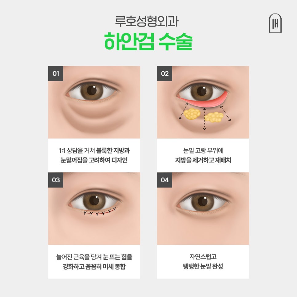 무거운 눈밑을 가볍게 바꿔준 하안검수술 효과 살펴보기 관련 이미지 4