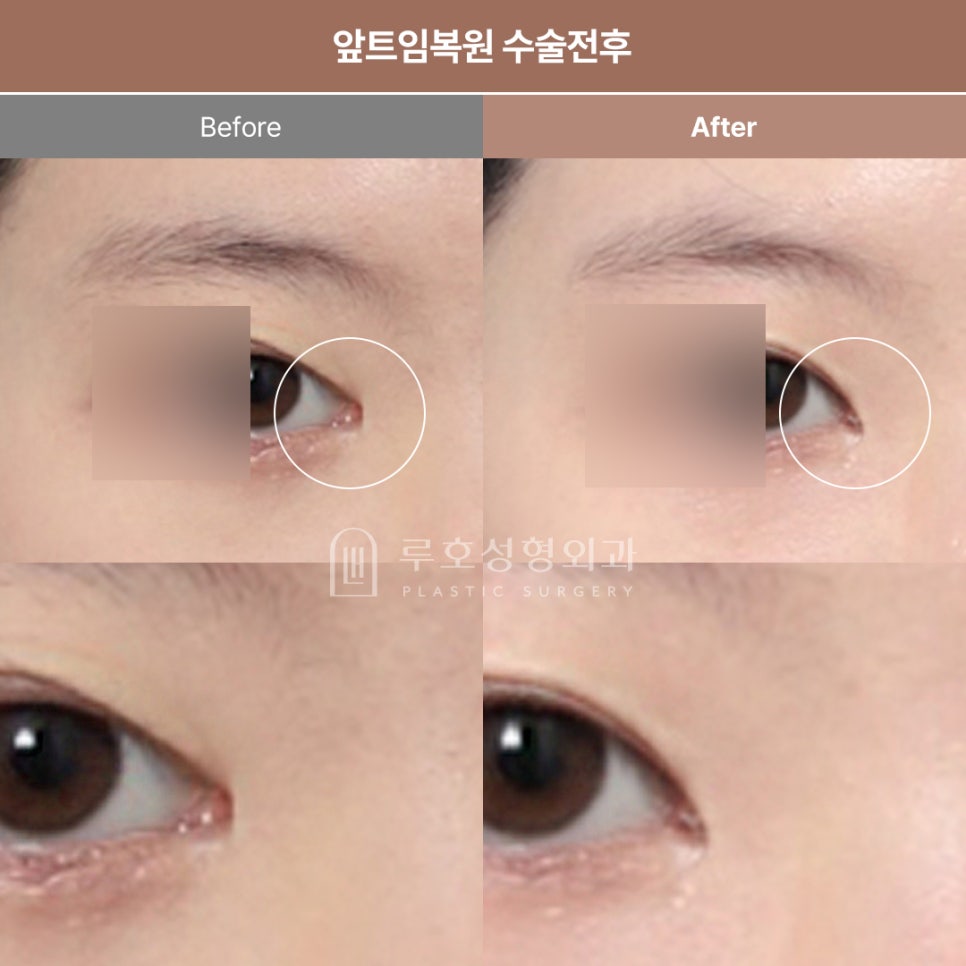 신사역 앞트임 복원, 언제 필요할까요? 관련 이미지 1