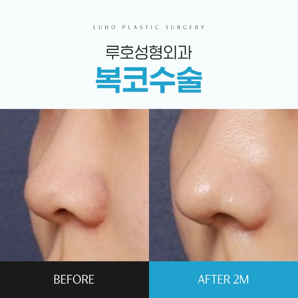 Bulbous Nose Surgery Before and After at Sinsa Station: Achieving the Desired Contour image 1