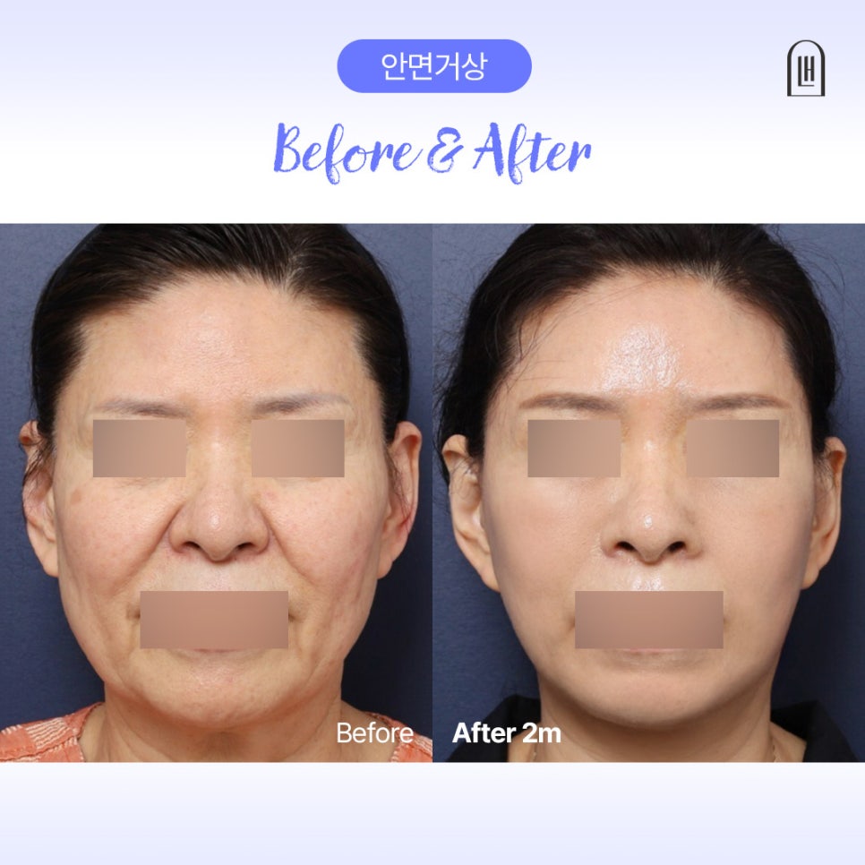 강남 신사역 안면거상술, 팔자주름 리프팅만으로 부족했던 이유 관련 이미지 1