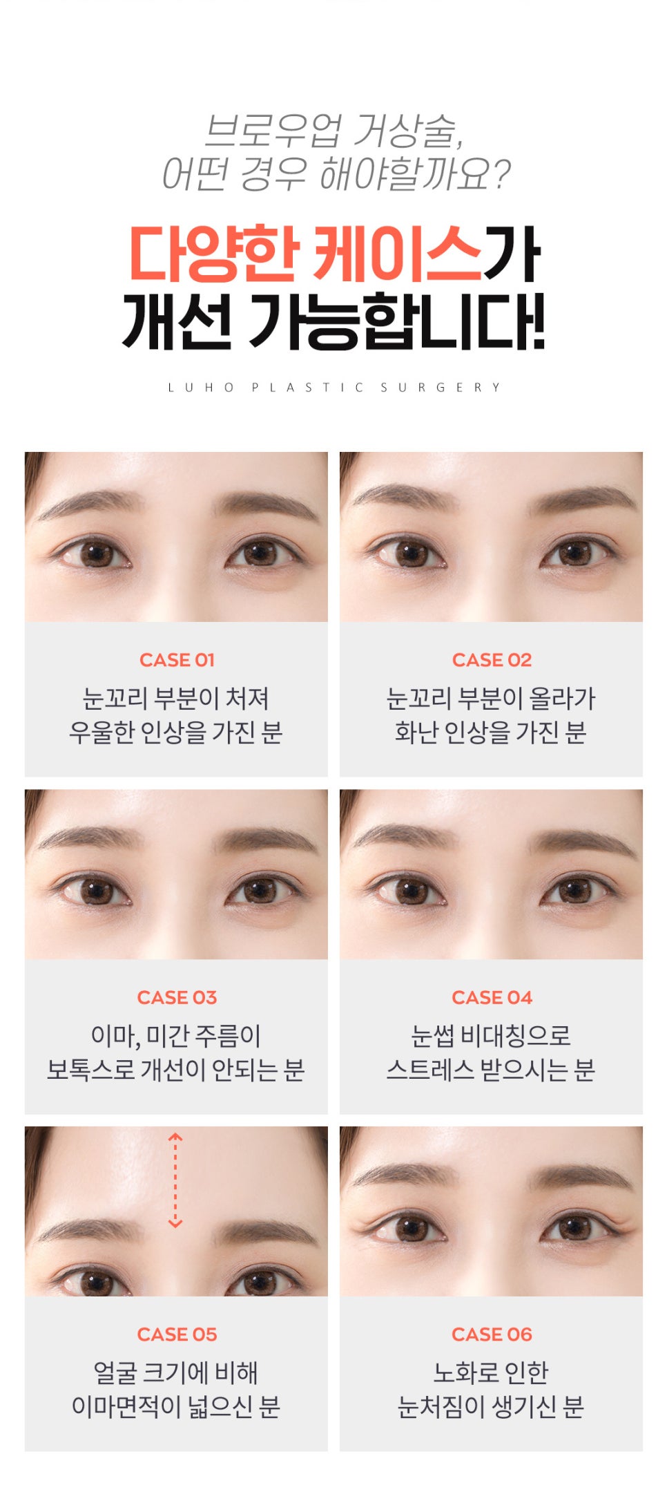루호성형외과의 이마 거상술로 처진 눈과 리프팅효과까지! 관련 이미지 4