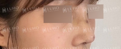 화려하고 또렷한 코 라인으로 개선한 수술 후기 관련 이미지 7