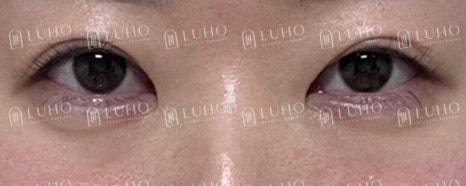 How Revision Eye Surgery Changed Uneven Eyes and a Sleepy-Looking Eye Shape image 3