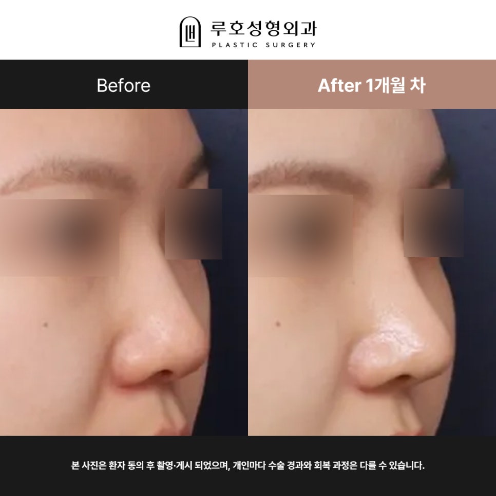 신사역 복코 재수술 전후 : 얄쌍한 콧대로 바뀐 사례 관련 이미지 1