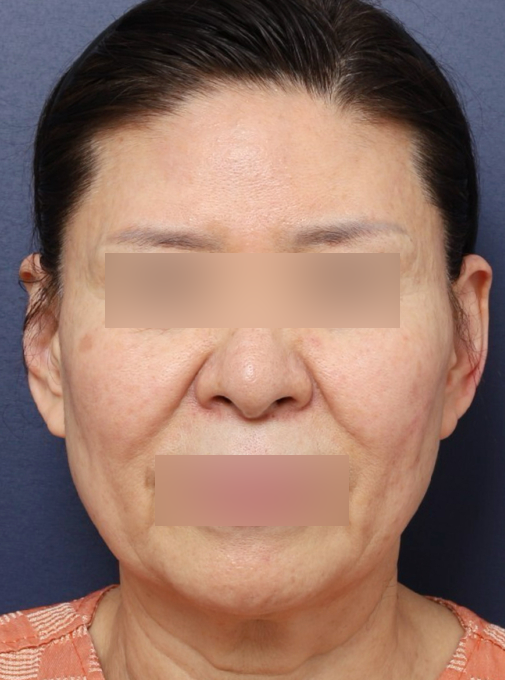 신사역 60대 안면거상 피부가 아닌 관련 이미지 2