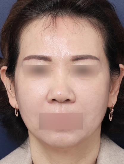 처진 얼굴선이 고민이었던 안면거상 사례 관련 이미지 5