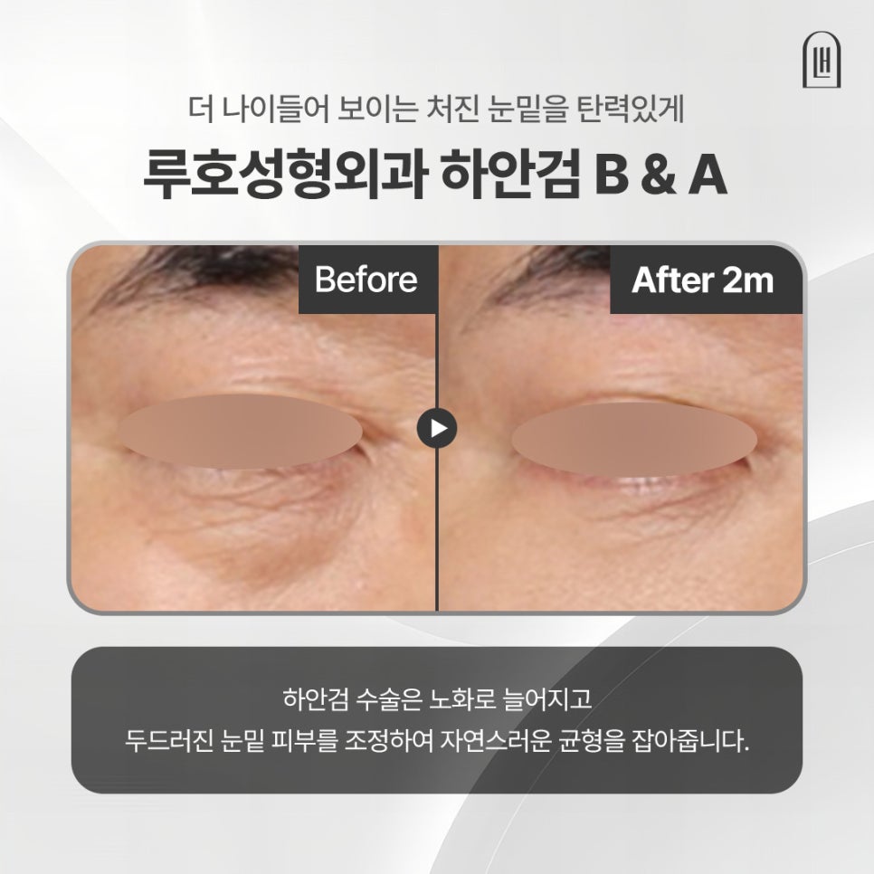 The Effects of Lower Blepharoplasty That Transformed Sagging Under-Eye Skin image 1