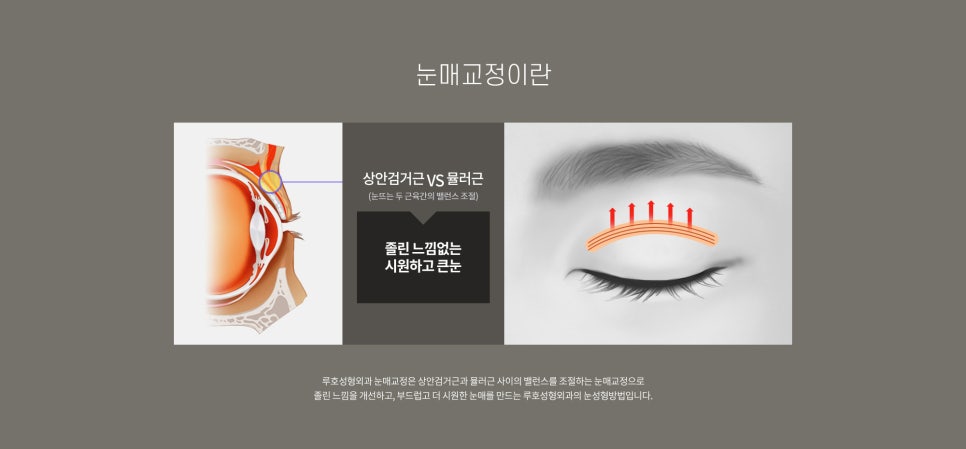 눈 수술법의 종류와 회복기간 #1 관련 이미지 5