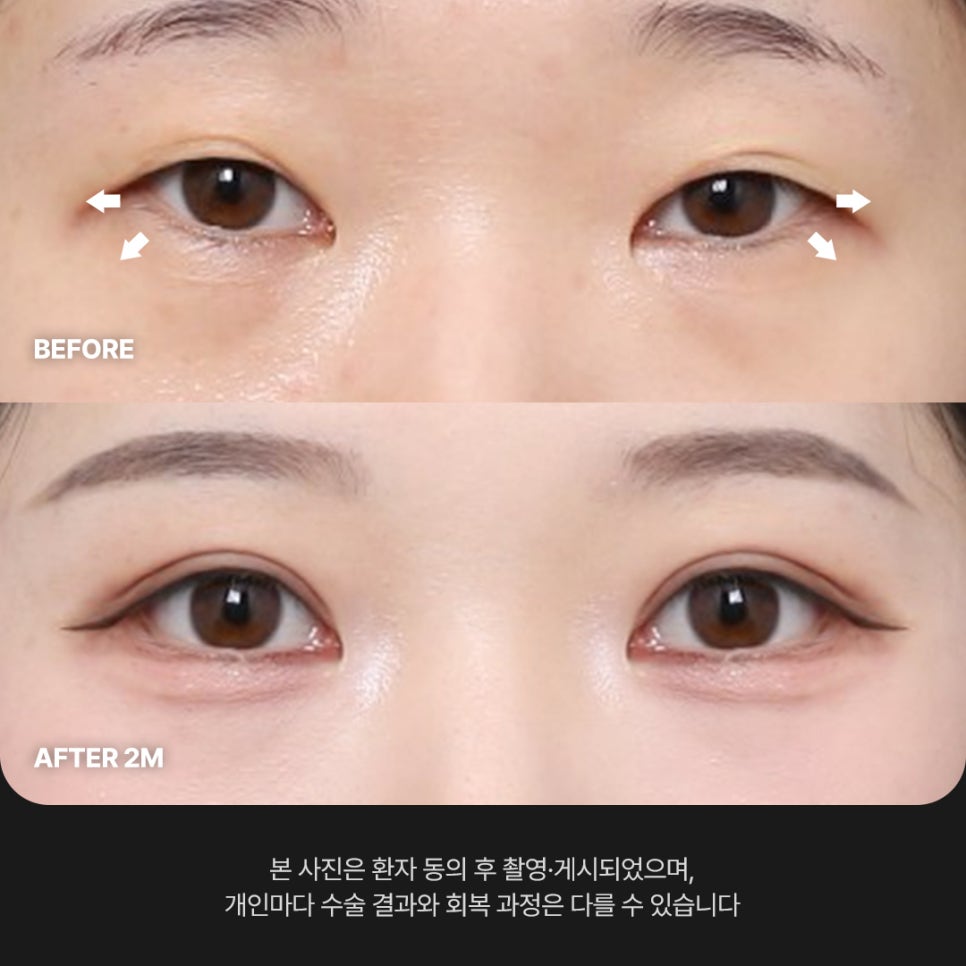 Ruhos Plastic Surgery — Real Review of Outer and Lower Eye Corner Surgery for Tired-Looking Eyes Before and After image 3