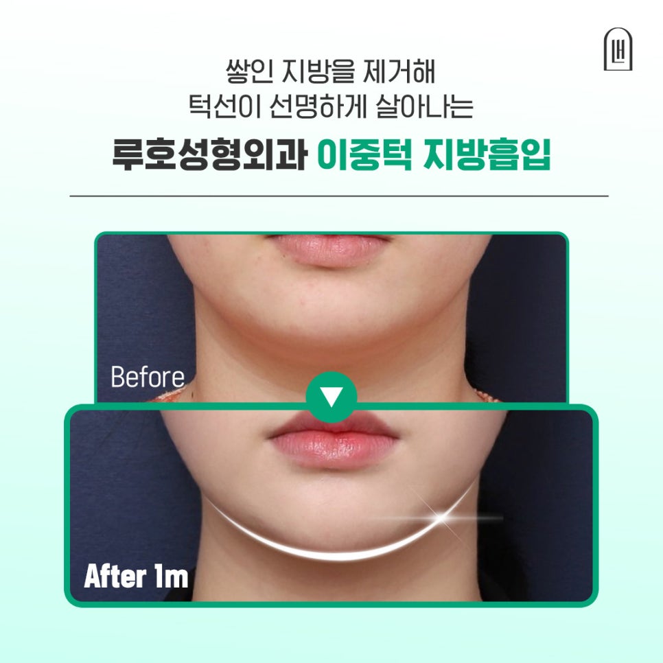 How Chin Contouring Changed with Double Chin Fat Removal image 1